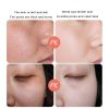 Anti Stains Acne Treatment Cream Scar Blackhead Face Cream Shrink Pores Whitening Skin Care Face Cream Korean Cosmetics - 15G